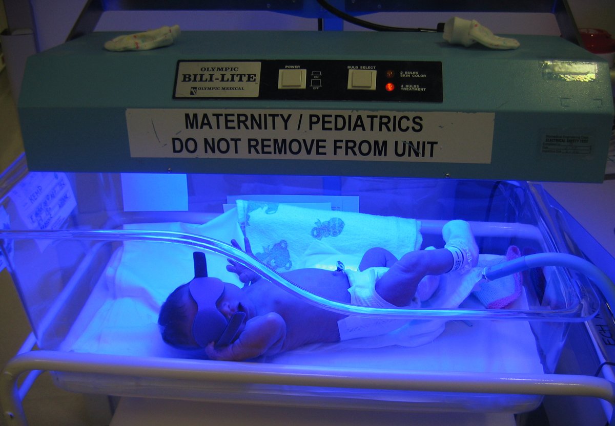 Infant undergoing bili light therapy in a United States maternity ward